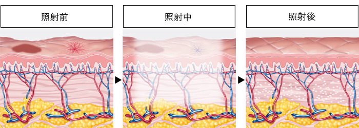 フォトフェイシャル(照射前・照射中・照射後)