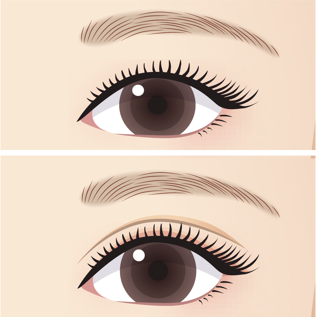 二重切開デザイン