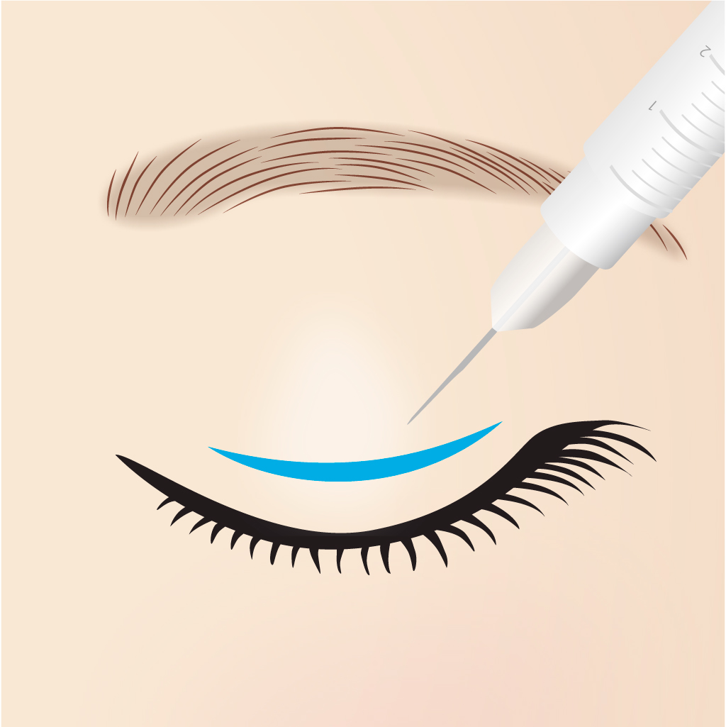 二重切開デザイン