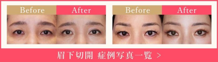 眉下切開 症例写真一覧