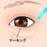 マーキング