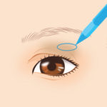 上まぶたのくぼみ修正01