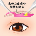 眉下皮膚切除03