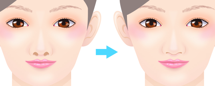 鼻孔縁軟骨移植