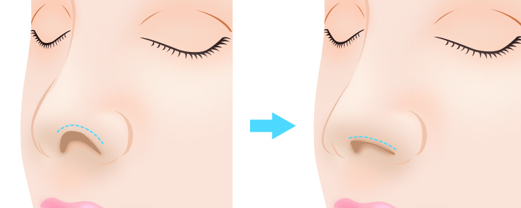 鼻孔縁軟骨移植