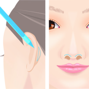 鼻孔縁軟骨移植