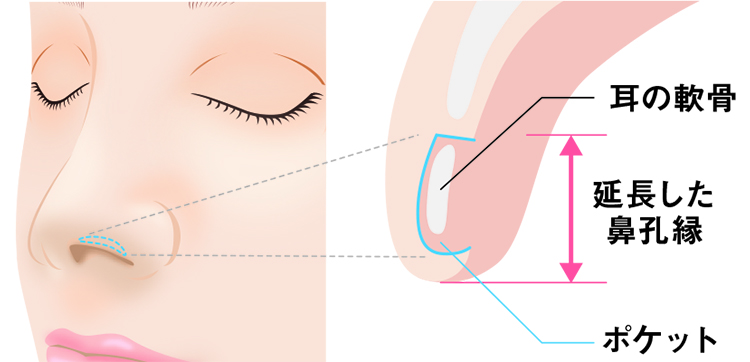 鼻孔縁軟骨移植