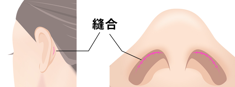 鼻孔縁軟骨移植