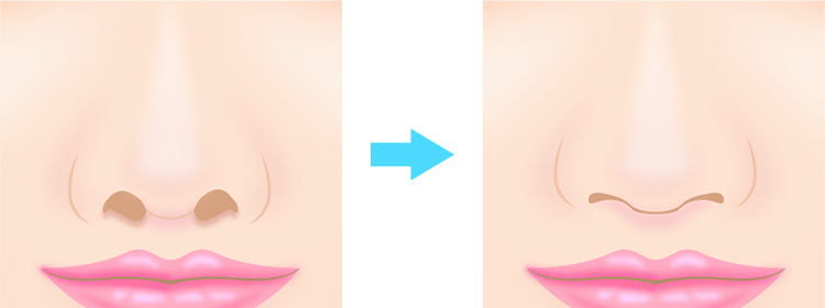 鼻孔縁軟骨移植