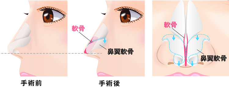 鼻中隔延長(豚鼻改善)とは