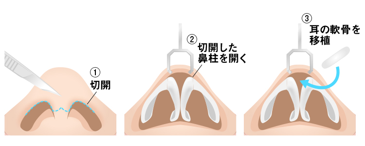 鼻中隔延長手術