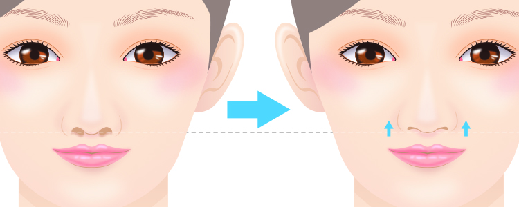 鼻翼挙上とは