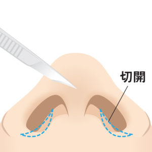 鼻翼縮小（小鼻縮小） 内側切開法デザイン
