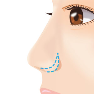 鼻翼縮小（小鼻縮小） 外側切開法デザイン