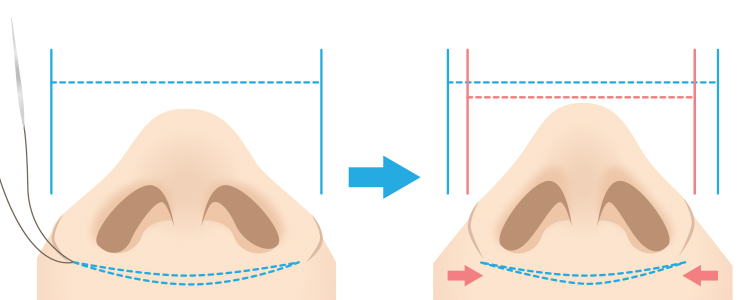 鼻翼縮小（小鼻縮小） 埋没法手術 