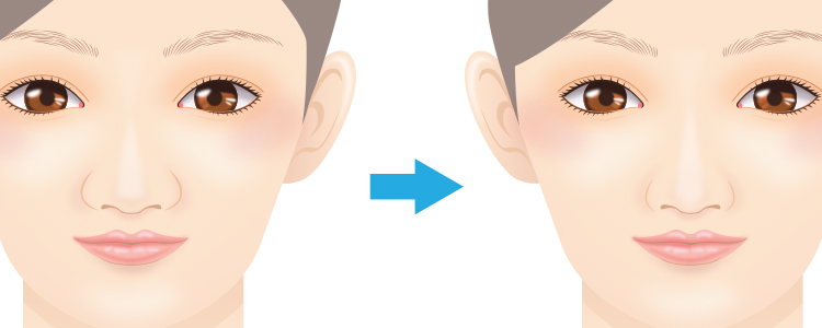 小鼻縮小の効果について