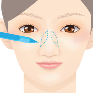 鼻骨切幅寄せ デザイン