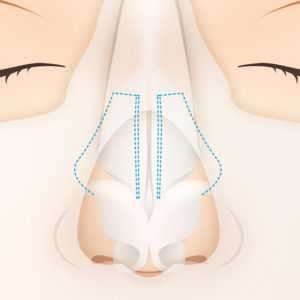 鼻骨切幅寄せ 手術