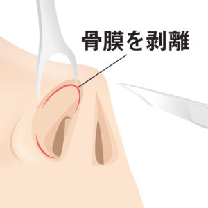鼻骨切幅寄せ 麻酔・手術