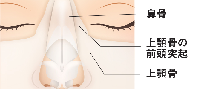 鼻骨切幅寄せ 手術