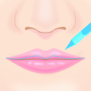 M字リップ形成術