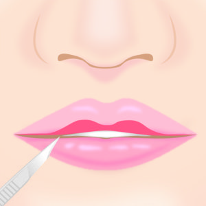 M字リップ形成術