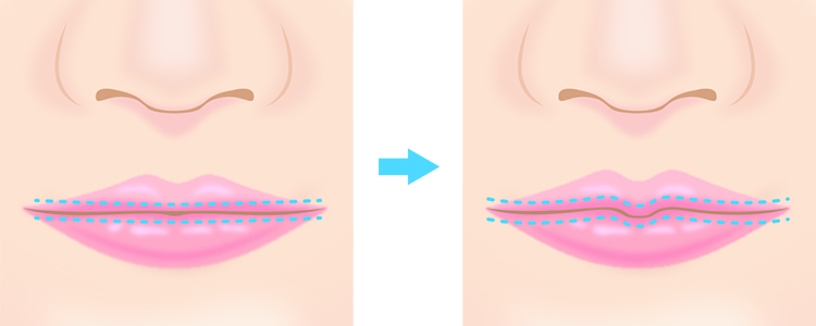 M字リップ形成術