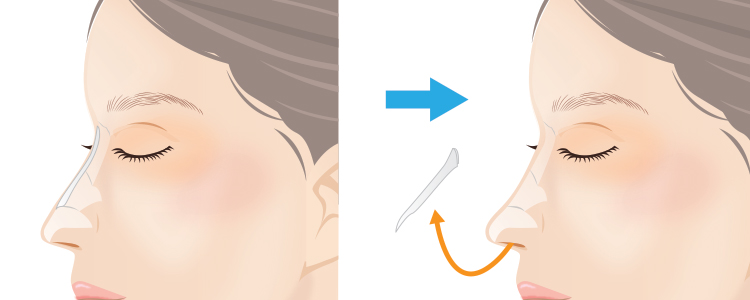 プロテーゼ抜法