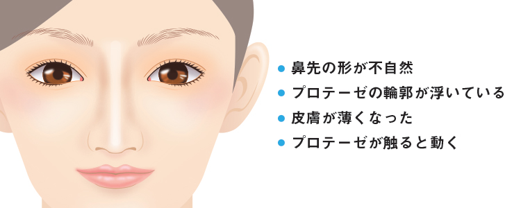 プロテーゼ抜法