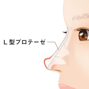 プロテーゼ抜法