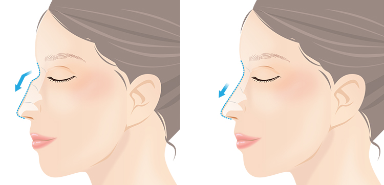 わし鼻段鼻修正