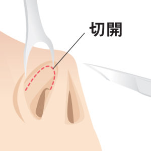 わし鼻段鼻修正