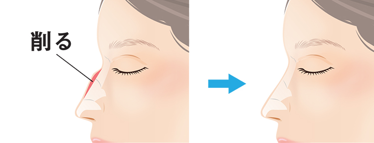 わし鼻段鼻修正