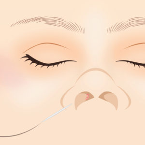 わし鼻段鼻修正