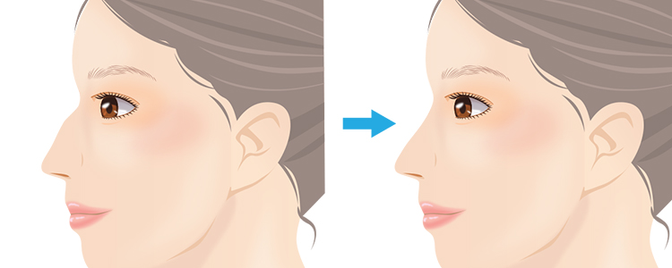 わし鼻段鼻修正