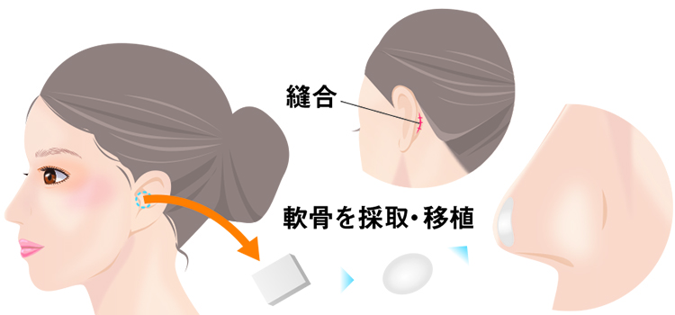 耳介軟骨移植