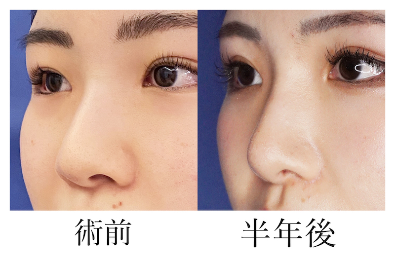 骨切り幅寄せ_a