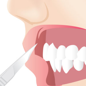 ガミースマイル手術