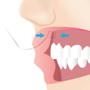 ガミースマイル手術