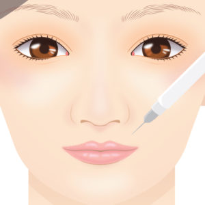 ガミースマイル手術