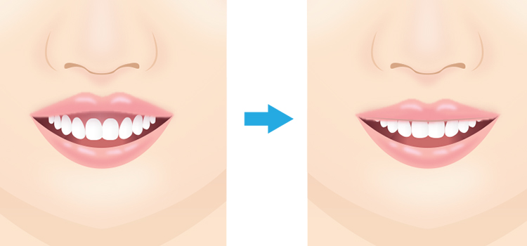 ガミースマイル手術