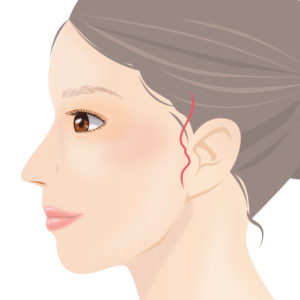 ミニフェイスリフト