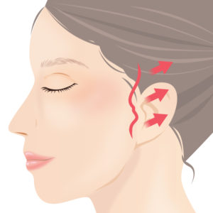 ミニフェイスリフト 手術