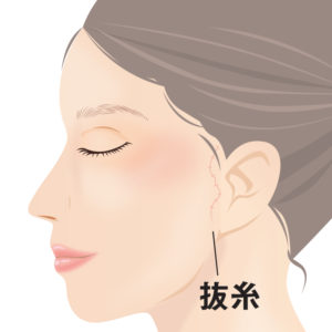 ミニフェイスリフト 抜糸