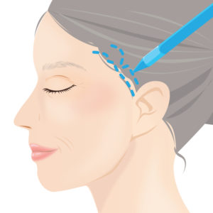 コメカミリフト