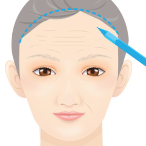 額リフトデザイン