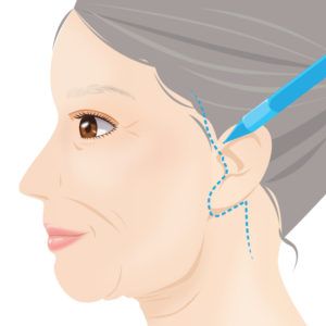 フェイスリフトカウンセリング