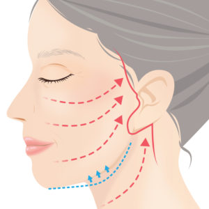 フルフェイスリフト手術