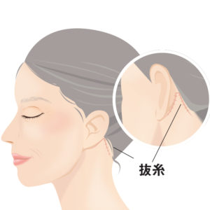 ネックリフト抜糸