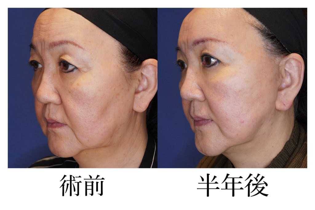 切開フルフェイスリフトアップ